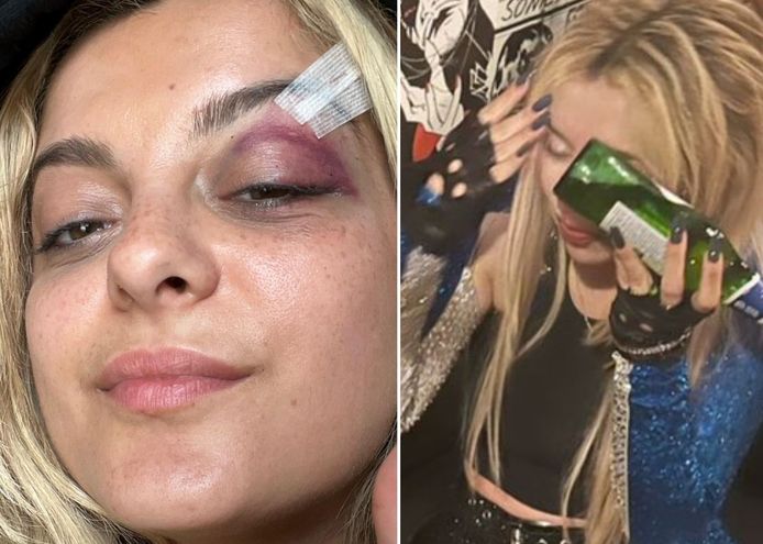 Left: Bebe Rexha was shot in the eye.  Right: Ava Max cools her eye with a bottle after the accident.