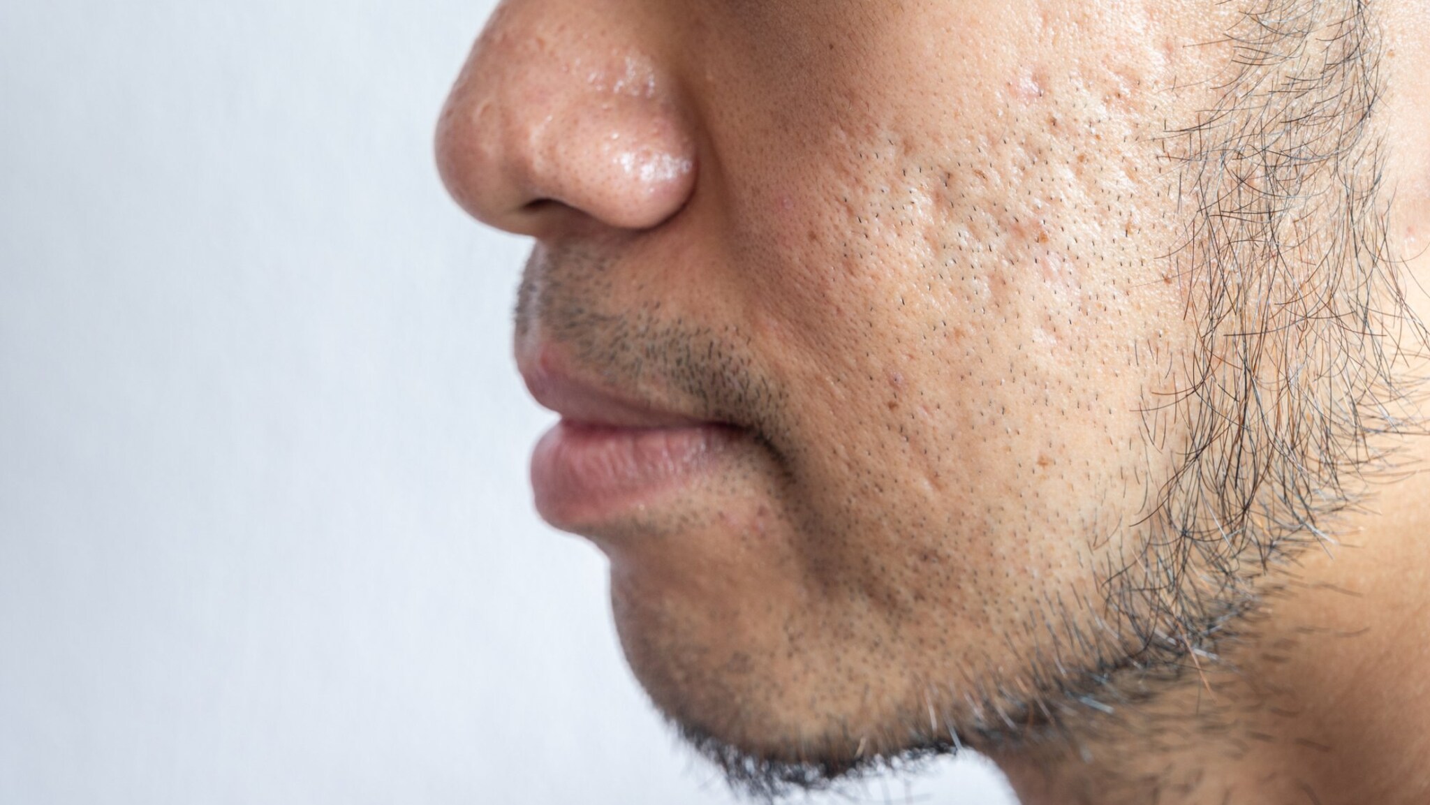 Joke: My son has acne scars on his face.  How can we get that away?